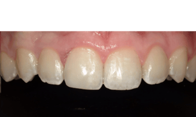 Composite-Breakage-Repair-After-Image