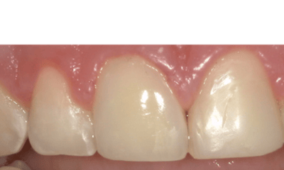 Composite-Breakage-Repair-After-Image