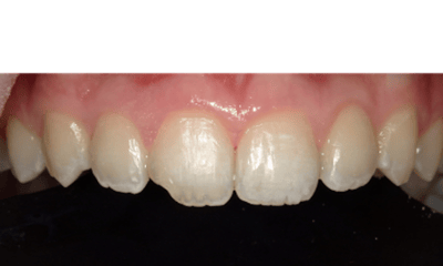 Composite-Breakage-Repair-Before-Image