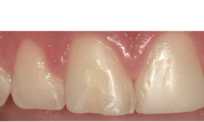 Composite-Breakage-Repair-Before-Image